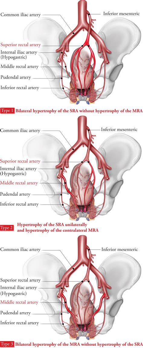 Rectal Artery Embolization For Hemorrhoidal Disease Anatomy