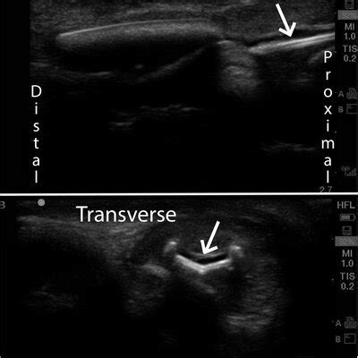 Longitudinal View Of Urethra With Foley Balloon Right Used To Remove