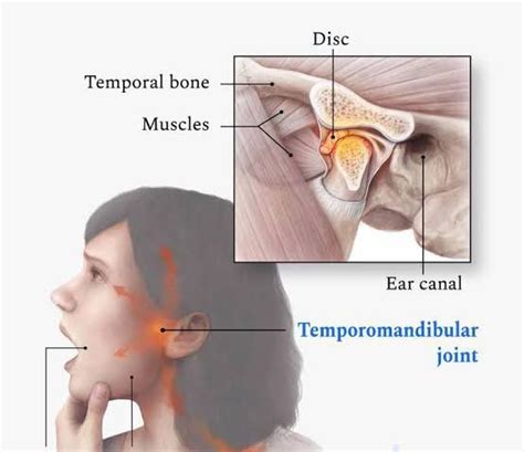 TMJ DISORDER Symptoms MEDizzy