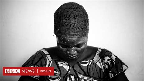 Monkeypox Symptoms Di Nigerian States Wia E Dey Plus All You Need To