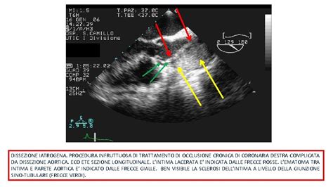 Imaging Nelle Sindromi Aortiche Pocket Book 2017 2018