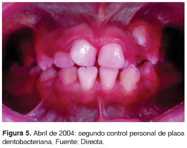 Enfermedad Periodontal En Pacientes Adolescentes Con S Ndrome De Down