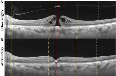 Representative Swept Source Optical Coherence Tomography Ss Oct