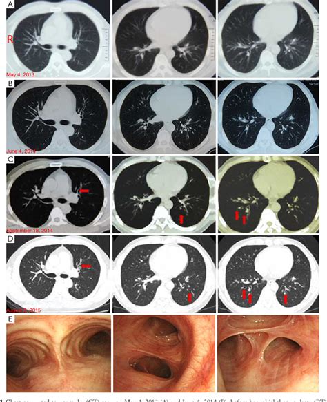 Figure From Bronchiectasis After Bronchial Thermoplasty Semantic