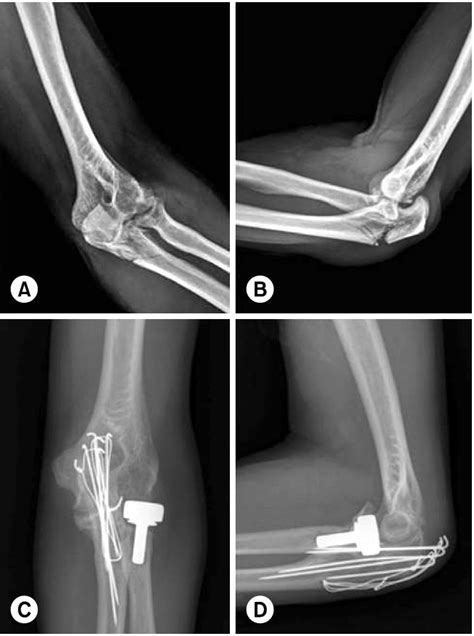 Preoperative Antero Posterior A And Lateral B Radiographs Show A Download Scientific