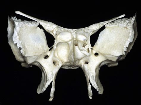 Superior Orbital Fissure Sphenoid