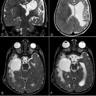 Preoperative A And Postoperative B T Weighted Mri Sequences Of A