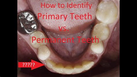 How To Identify Primary Teeth Vs Permanent Teeth Youtube