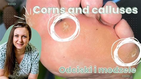 Corns And Calluses Odciski I Modzele YouTube