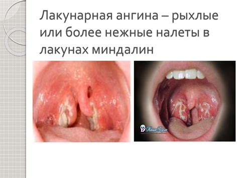 Принципы и методы лечения пациентов с синдромом тонзиллита. Тактика ...