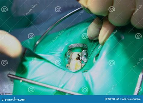 Deep Caries On The Baby Tooth Operation Under General Anesthesia