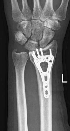 Distal Radius Fracture Volar Locking Plate Fixation Radiology Case