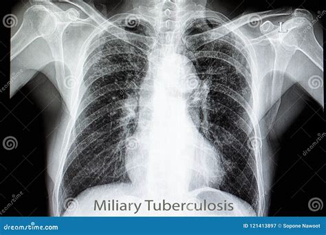 Miliary Pulmonary Tuberculosis Stock Image Image Of Antibiotic