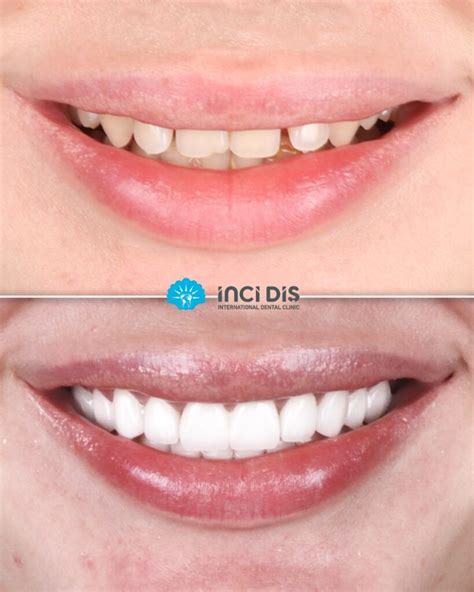 Zirconia Crown Before And After