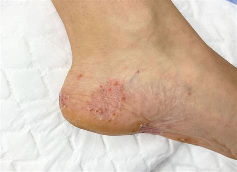 Fungal Skin Infection Management In Singapore Straits Podiatry