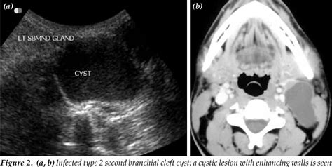 Figure From Imaging Of Cystic Neck Masses In Adults Semantic Scholar