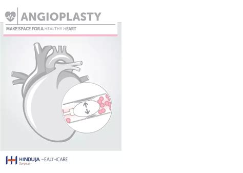 Ppt Angioplasty Make Space For A Healthy Heart Powerpoint