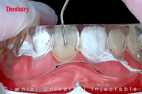 Injection Moulding Technique With G Nial Universal Injectable Dentistry