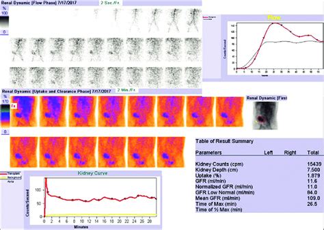 Dynamic Renal Scintigraphy Upper Three Rows Represent Perfusion Lower