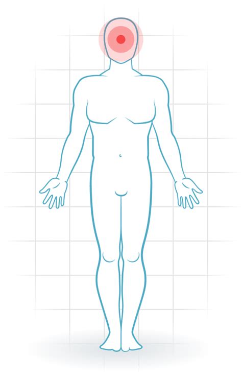 Pijnlocatie Cefalea Cervicog Nica