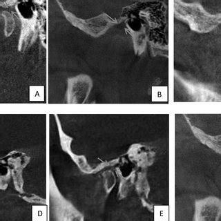 Tunnel types for petrotympanic fissure. A: Type 1, B: Type 2, C: Type... | Download Scientific ...