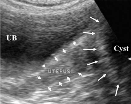 Gartners Duct Cyst Ultrasound