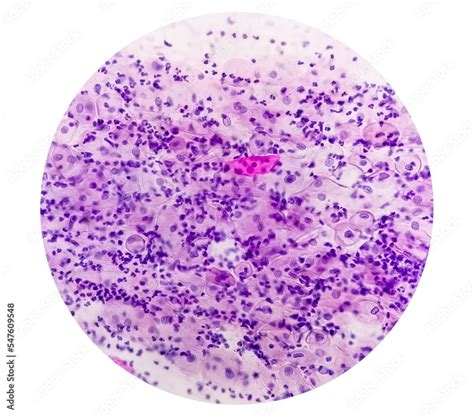 Paps Smear Microscopic Examination Of Pap Smear Showing Inflammatory Smear With Early Atrophic