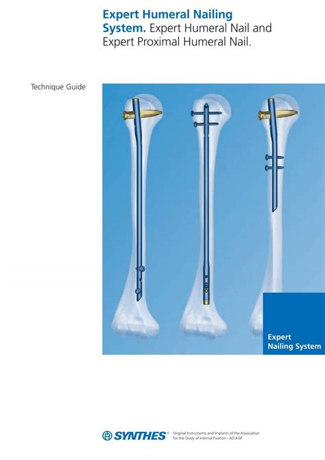 Expert Humeral Nailing System - Synthes