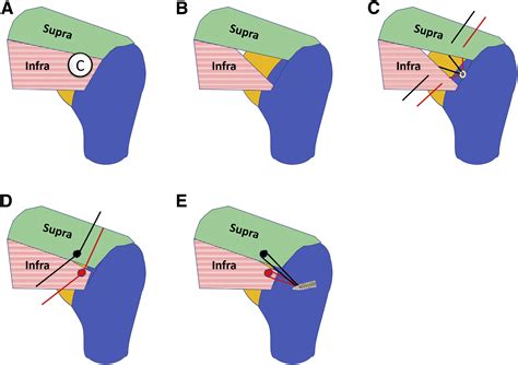 Arthroscopic Excision Of Infraspinatus Calcific Tendinitis With Double