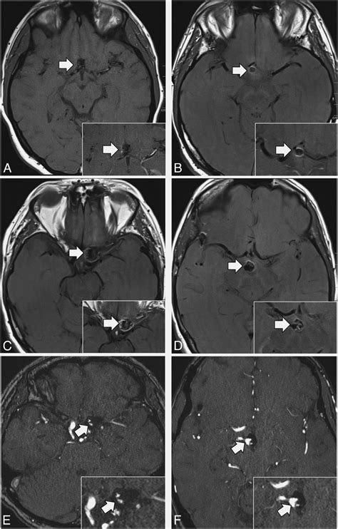 Wall Enhancement Of Coiled Intracranial Aneurysms Is Associated With