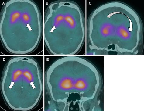 Practical Overview Of I Ioflupane Imaging In Parkinsonian Syndromes