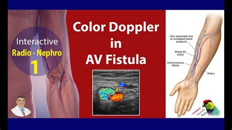 Doppler AV Fistula Radiology Nephrology Interactivity 1 YouTube