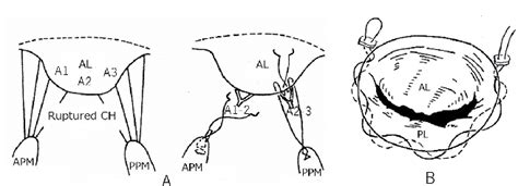 Basic Mitral Valve Plasty Techniques Artificial Chordal Reconstruction Download Scientific