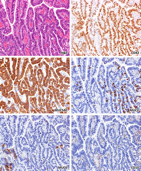 Intramucosal Well Differentiated Adenocarcinoma According To The