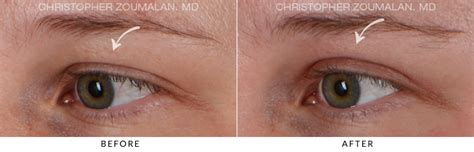 Upper Lid Blepharoplasty Before And After Photo Gallery