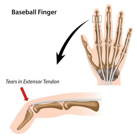 Dallas Extensor Tendon Injury Treatment - Loredo Hand Care Institute