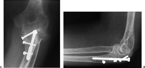 Management Of Olecranon Fractures And Nonunion Teachme Orthopedics