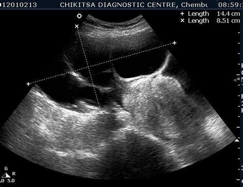 Mucinous Cystadenoma Ultrasound