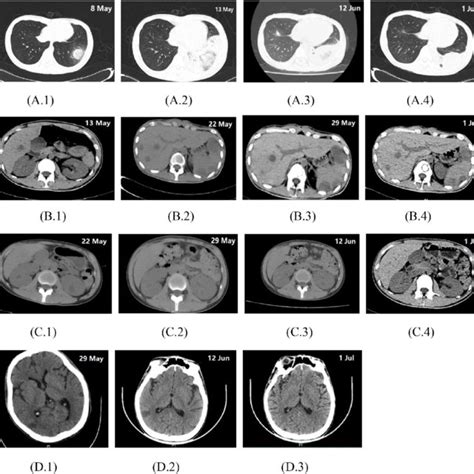 Serial High Resolution Computed Tomography Ct Scans Download