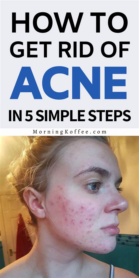 Simple skin care routine for acne get rid of acne only in 5 steps – Artofit