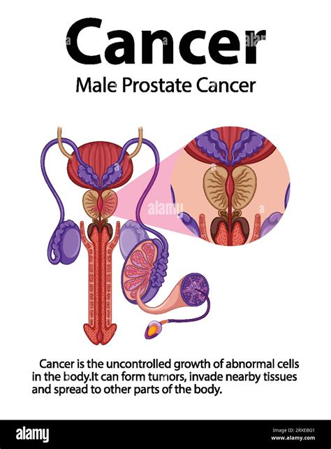 Infographic Illustrating The Differences Between Normal And Cancerous