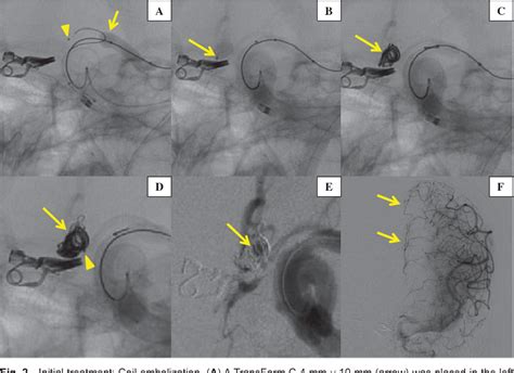 Figure 2 From A Case Of Ruptured Anterior Communicating Artery Aneurysm