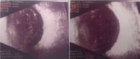 Photos Of Left Eye Fundus Of The Patient P After Vitrectomy Пациенту Download Scientific