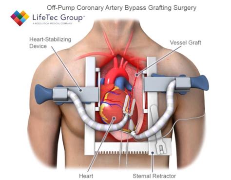 Minimally Invasive Coronary Artery Bypass Lifetec Group