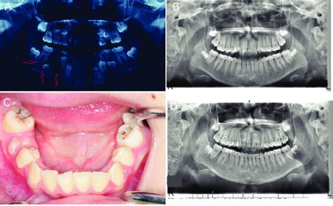 Treatment Of Radicular Cyst With Decompression A A Radiograph Shows Download Scientific