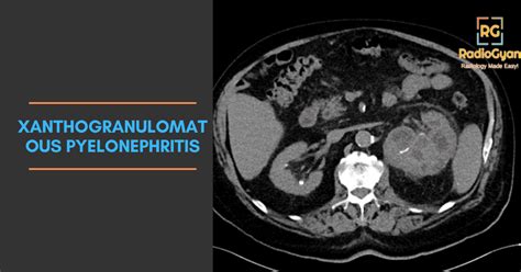 Canal Of Nuck Cyst Radiology Cases Com Radiogyan