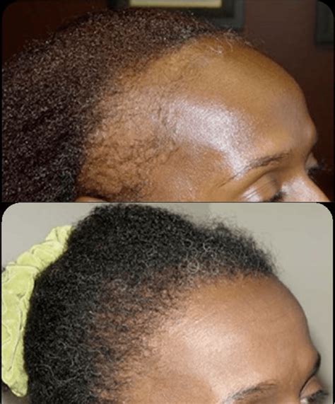 African American Hair Transplant Photos Ziering Medical