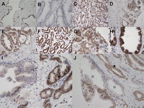 Representative Ihc Images Of Erg Expression In The Uk And Chinese