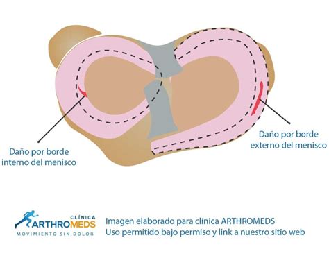 Operación De Lesión De Meniscos Menisectomia Y Sutura