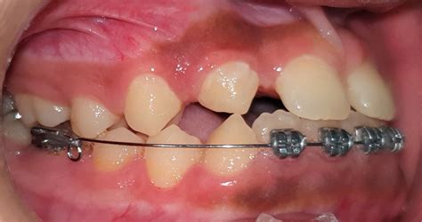 Lower Anterior Teeth Tipped Lingually And Correction Of The Crossbite